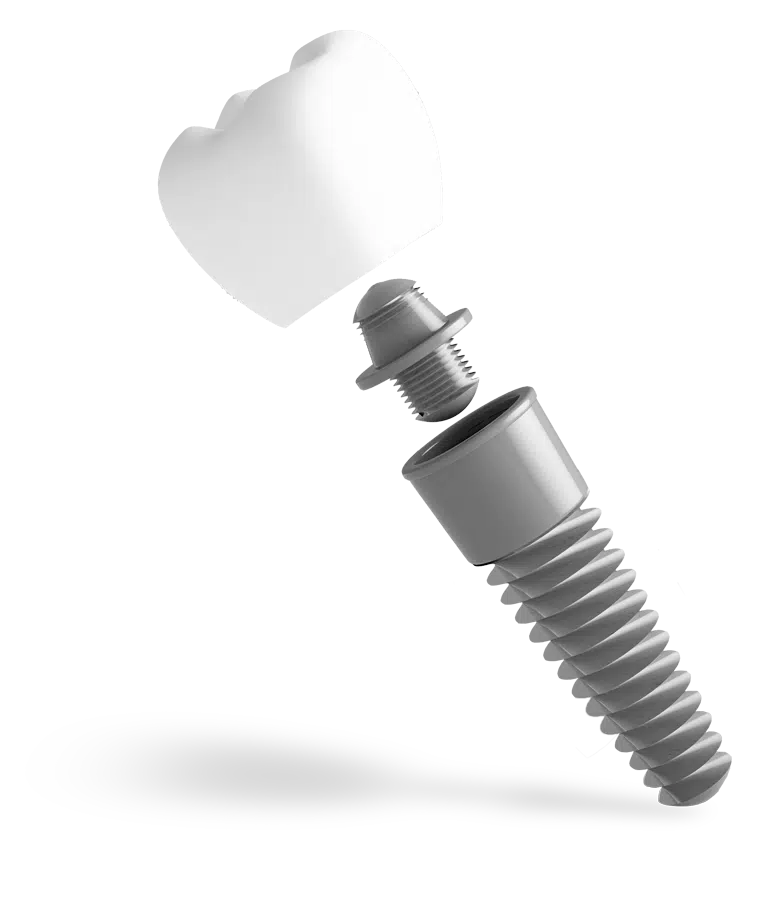 Implant dentar